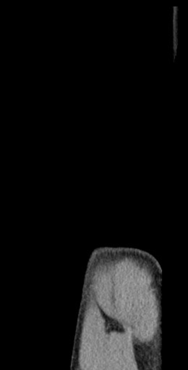 Schwarze und weiße MRI-Aufnahme eines Patientenknies mit detaillierter Knieanatomie.