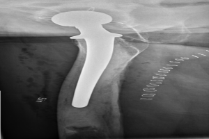 Röntgenbild einer Hüfte mit einem sichtbaren Bruch in der Mitte, mit detaillierter Abbildung zur Diagnose und Behandlung